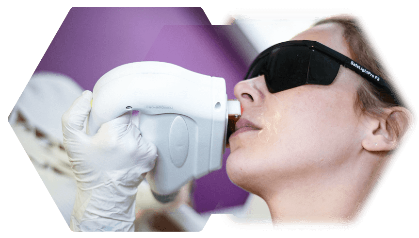 Photo treatment upper lip