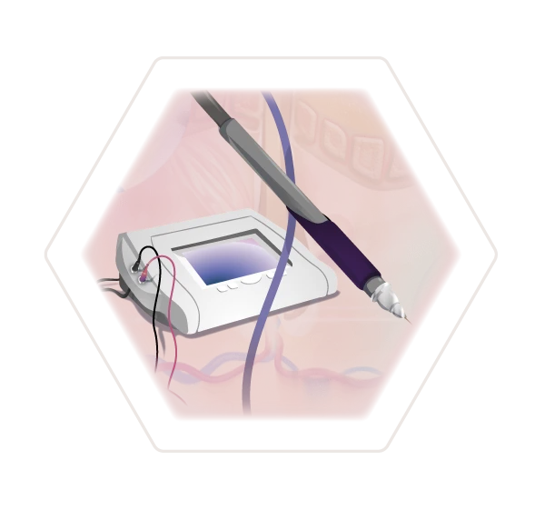 Illustration Technologie dauerhafte Haarentfernung Nadelepilation