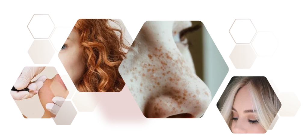 Fotokollage Hauttypen Nadelepilation helle Haut mit Pigmenten